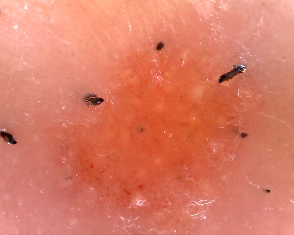 What does it look like? (photos) General Oozing Yellow Crusts forum