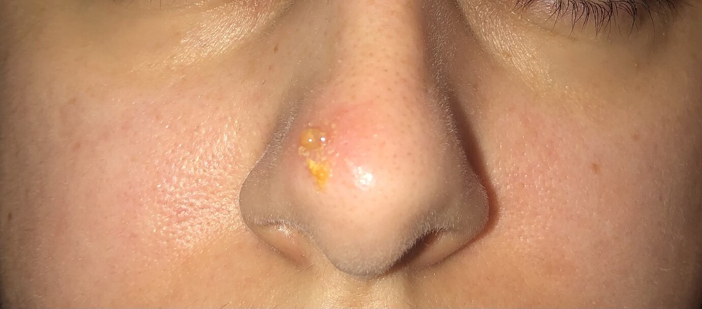 Oozing lesions are back ;( Treatments Oozing Yellow Crusts forum