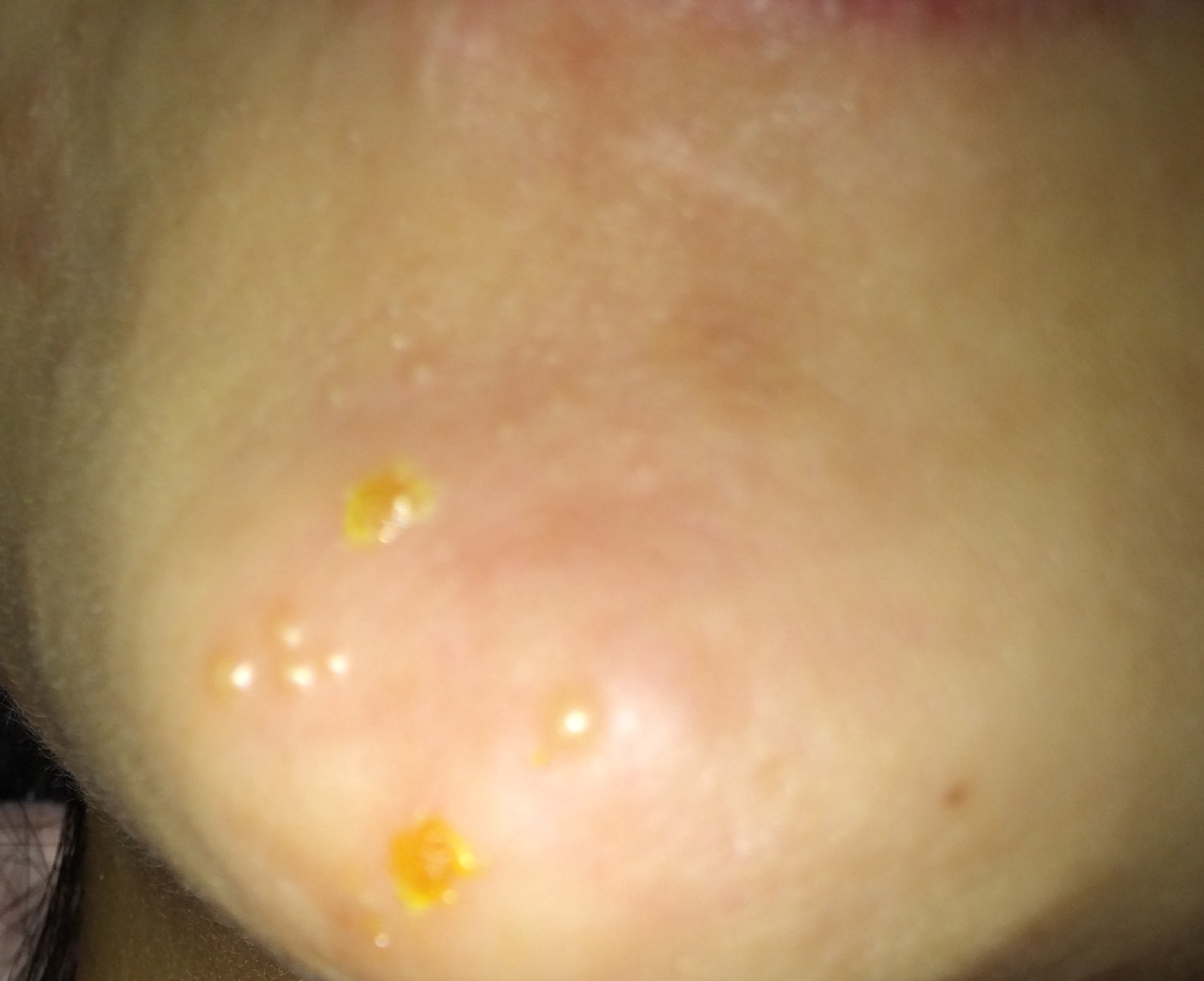 Bad first reaction - Treatments - Oozing Yellow Crusts forum